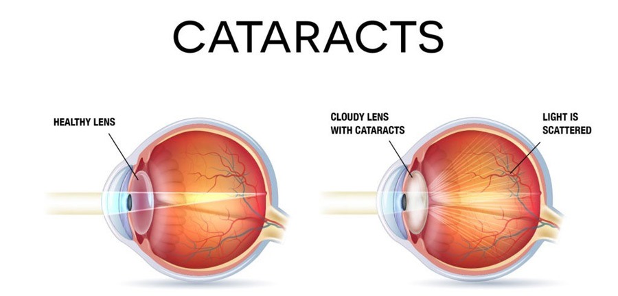 cataract surgery sydney