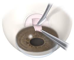 trabeculectomy for glaucoma sydney